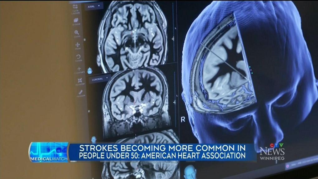 Strokes affecting more people under 50